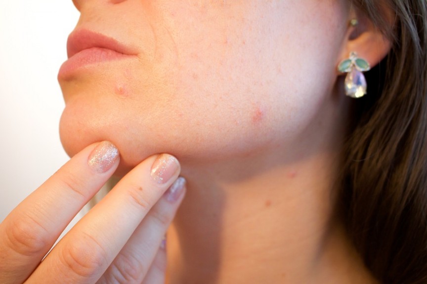 Traiter l'acné avec l'huile de castor : à quels résultats s'attendre ?